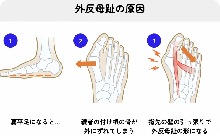外反母趾の原因の図解