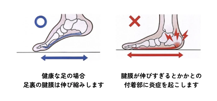 健康な足と足底腱膜炎の足を並べた比較図
