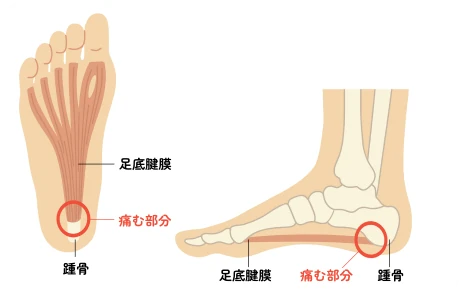 足底腱膜炎の図解